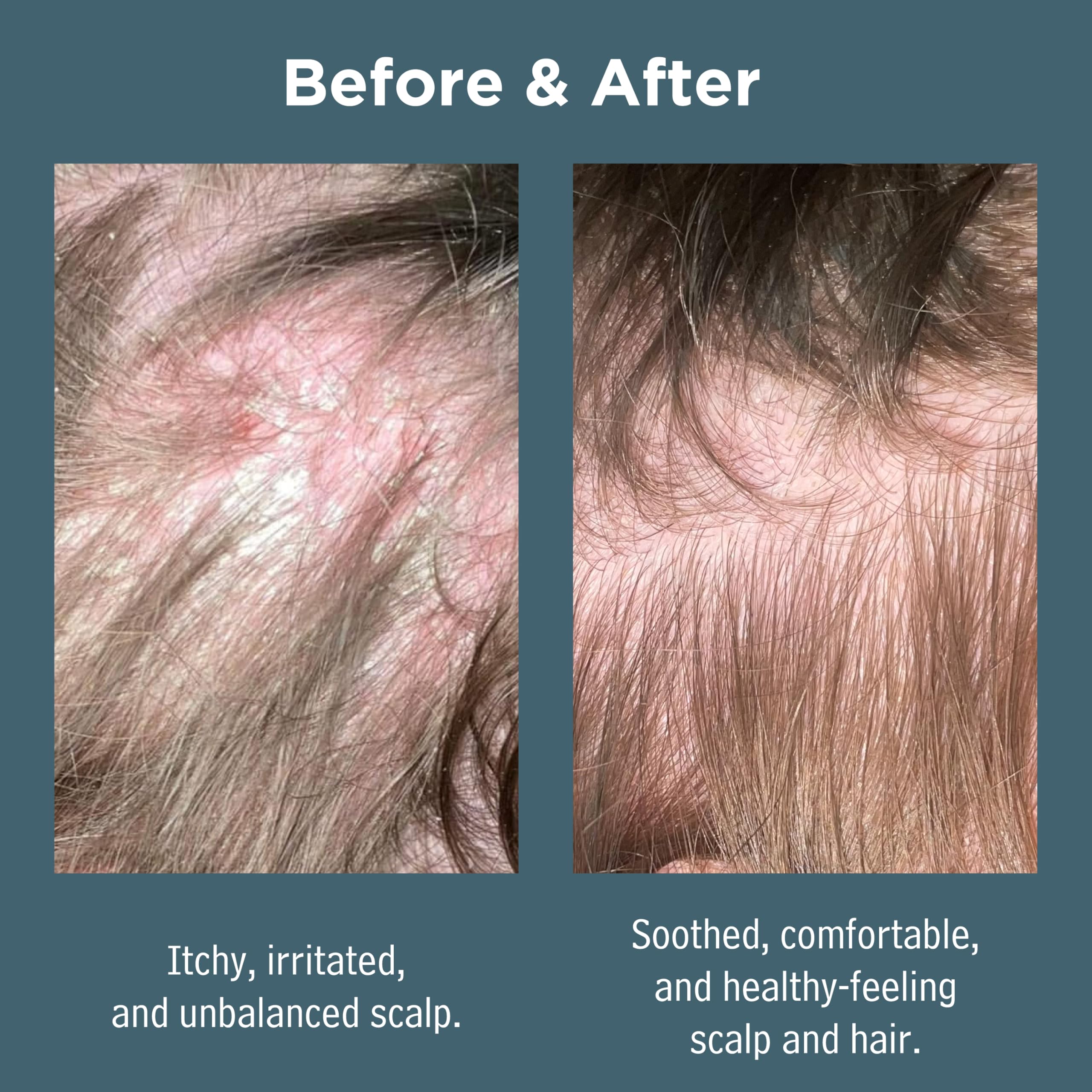 Sea Magik - Salicylic Acid Shampoo for Psoriasis & Itchy Scalp Relief, Soothing Antibacterial Seaweed Treatment for Medicated Conditions Like Folliculitis, Eczema & Scalp Acne, Cruelty-Free (300ml)